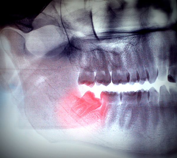 wisdom-tooth-pain